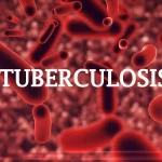 Tuberculosis