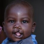 Babies-are-born-with-cleft