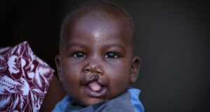 Babies-are-born-with-cleft