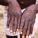 Monkey-pox-TVCNews