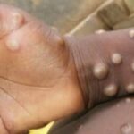 Monkeypox