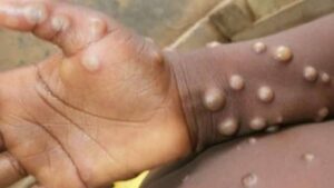 Monkeypox