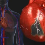 heart-disease-visual-guide-s2-heart-attack