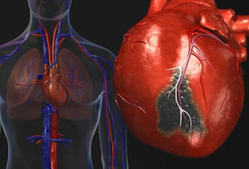 heart-disease-visual-guide-s2-heart-attack