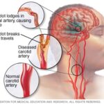 stroke