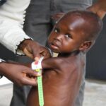 Malnutrition