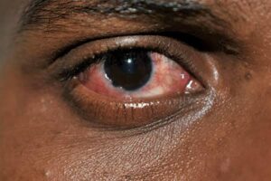 NAUTH, Nnewi outstation conducts 15 free surgeries, gives out 200 eyeglasses, provides other medicare for 500 patients