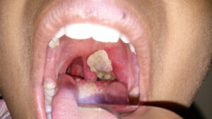 648x364_Diphtheria