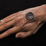 cutaneous-anthrax-on-arm