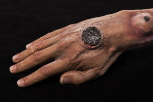 cutaneous-anthrax-on-arm