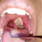 Diphtheria