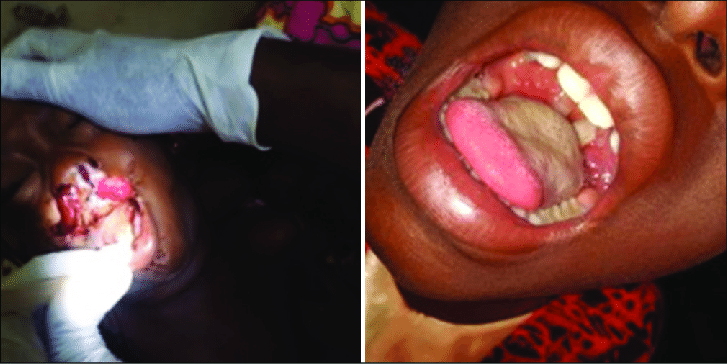 Picture-of-some-of-the-cases-of-diphtheria-showing-bull-neck-and-pseudomembrane
