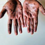 Global health alert: Mpox strain clade Ib rapidly spreading