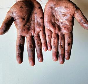 Global health alert: Mpox strain clade Ib rapidly spreading