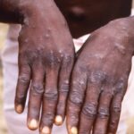 Monkeypox