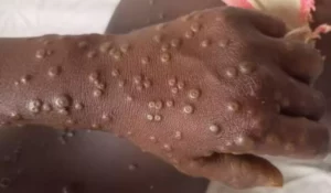 1831321-mpox