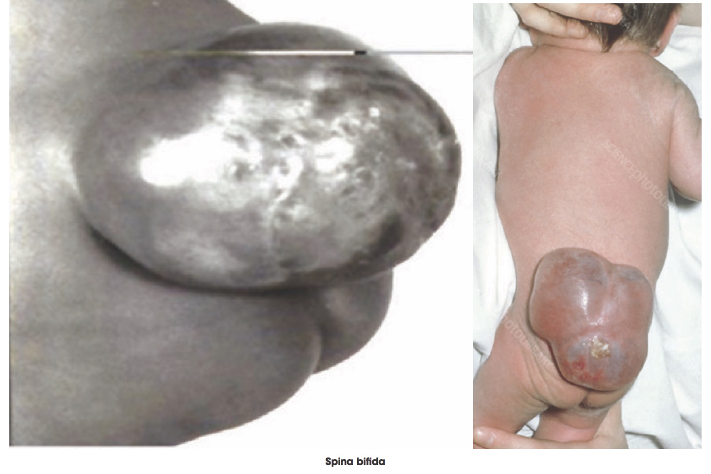 Spina bifida