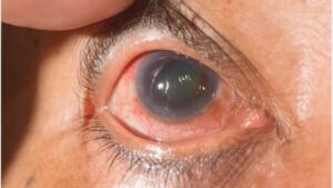 Eye