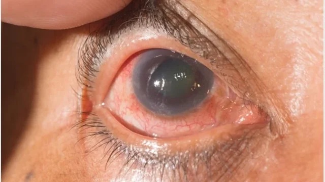 Eye