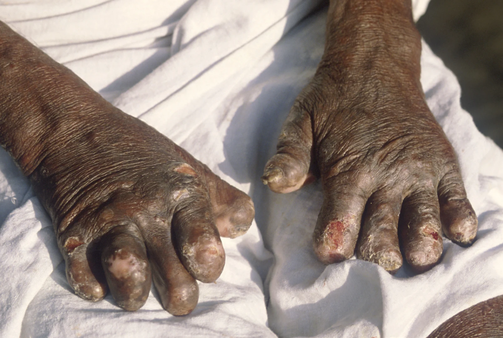 Leprosy