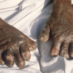 Leprosy