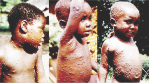 Children with Mpox