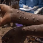 MPox