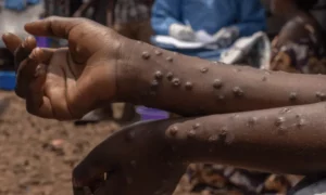 MPox