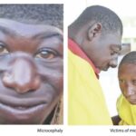 microcephaly