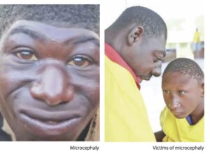microcephaly