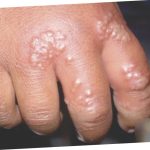 genital herpes