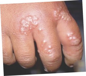 genital herpes