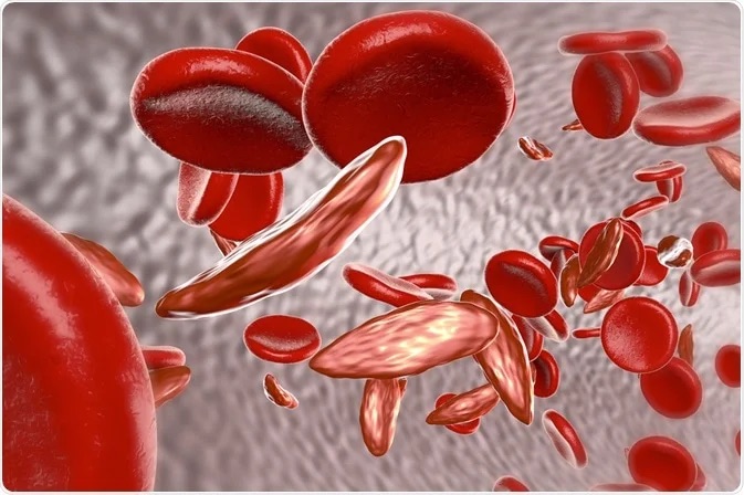 Nigeria records 150,000 sickle-cell births yearly, Oyo, foundation warn Jan 20, 2026