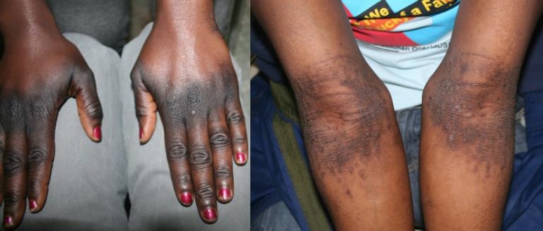 Skin Bleaching Risks The alarm over rising skin bleaching