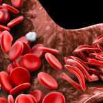 abc_sicklecell_scago