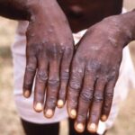Mpox-510×340