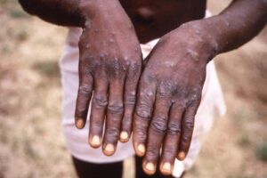 Mpox-510×340