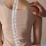 Scoliosis-1200×834-1-700×394