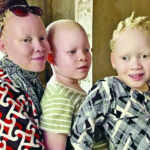 albinism