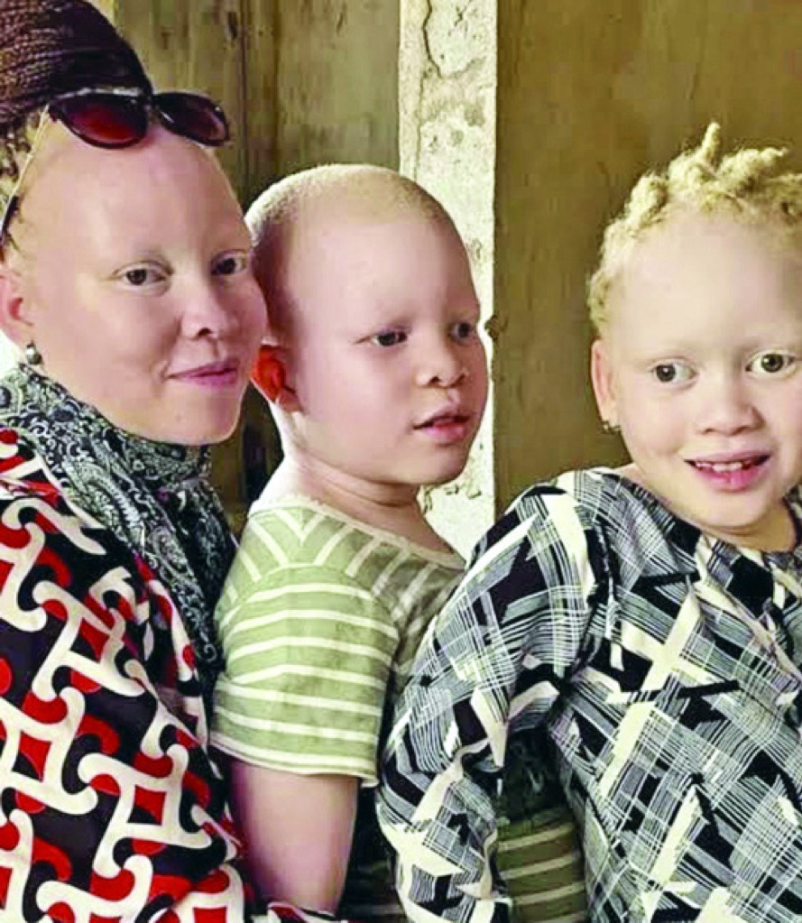 albinism