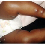 •Baby with Tumbu larva Photos- Google.com