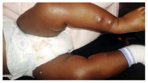 •Baby with Tumbu larva Photos- Google.com