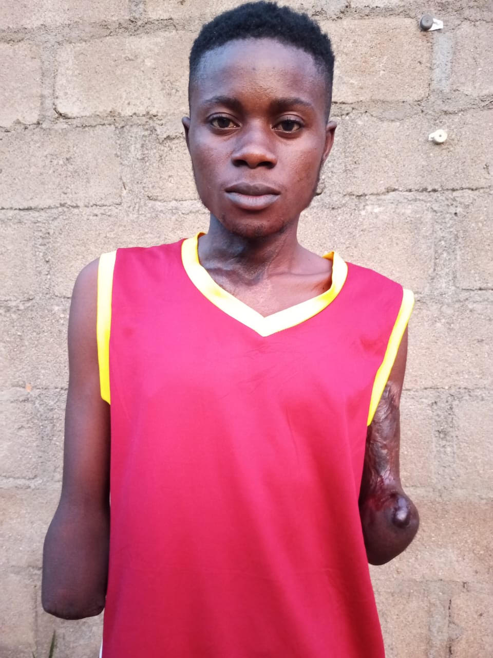 Electrocution survivor cries out to Governor Kefas for prosthetic limbs, employment